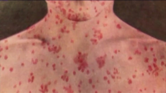 Measles confirmed in traveler who passed through LA County