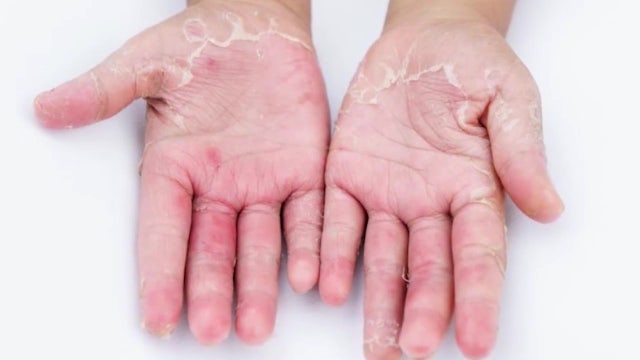 Remedies to help cure the dryness caused by hand-washing, sanitizing