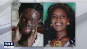 Acid attack survivor gets reconstructive surgery by Face Forward non-profit in Beverly Hills