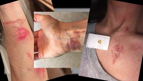 NutriBullet owners claim devices 'burst;' caused severe burns and cuts