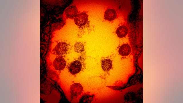 Cholesterol drug cuts coronavirus infection by 70%, researchers find