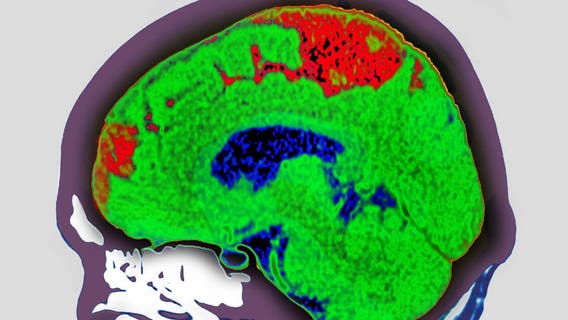 What is a cerebrovascular accident?