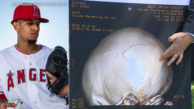 Lawsuit: Boy’s brain damaged by wild pitch thrown at Angel Stadium