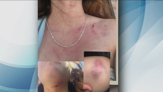 Teen girl assaulted during attempted robbery in Long Beach: police