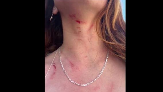 Teen girl fights off attackers in Long Beach