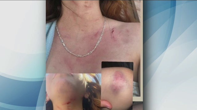 Teen girl assaulted during attempted robbery in Long Beach: police