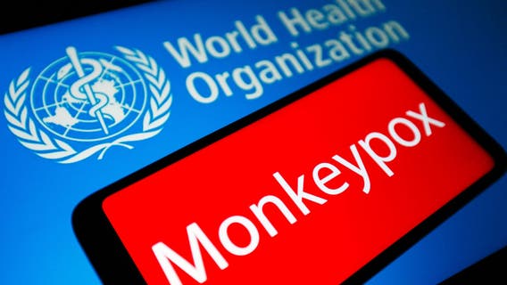 LA County reports 1st presumptive case of monkeypox