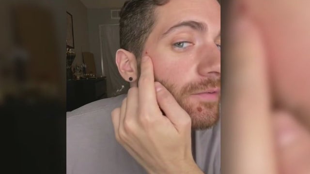 'You don't want it': LA man details battle with monkeypox