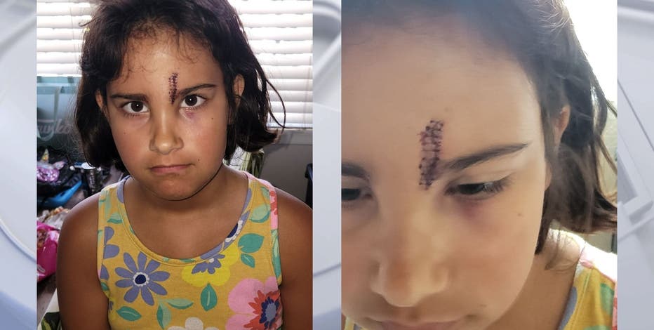 Girl gets stitches after flying cell phone hits her in face on Six