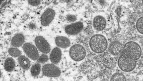 Riverside County reports 1st pediatric case of monkeypox