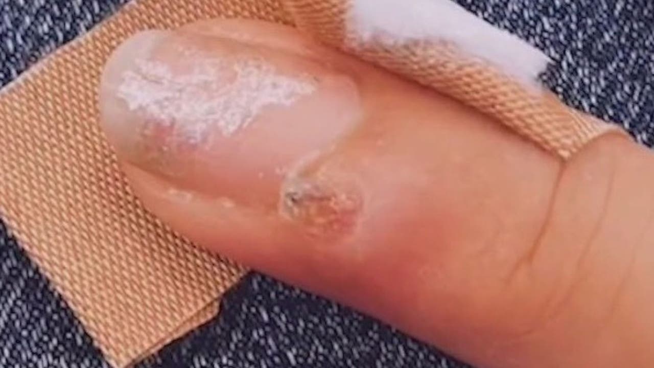 Woman warns others how manicure may have given her cancer Woman warns others how manicure may have given her cancer
