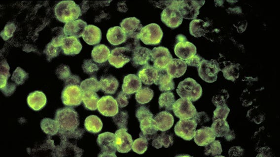 Florida man dies after contracting brain-eating infection from rinsing sinuses with tap water