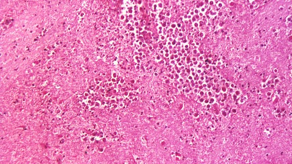 Nevada toddler dies from brain-eating amoeba