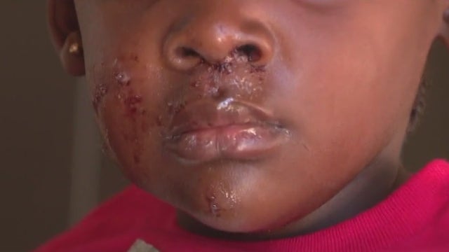 5-year-old LA County girl survives brutal dog attack