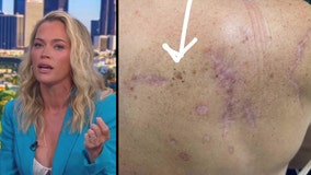 'Real Housewives' star Teddi Mellencamp shares personal battle with skin cancer