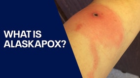 What is Alaskapox? 1st known deadly case reported