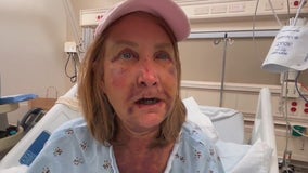 Woman's mouth wired shut after brutal attack in Venice