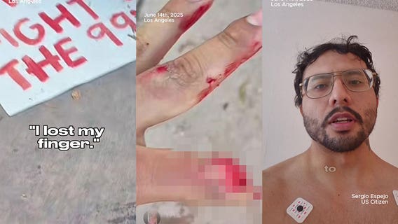 LA man sues LASD, alleging flashbang injury at "No Kings protest" led to amputation