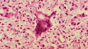 Measles outbreak: Case confirmed in traveler at LAX