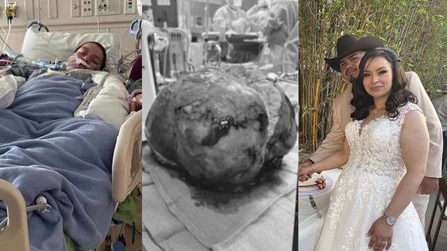 California woman gets married after lifesaving surgery to remove 40-pound tumor