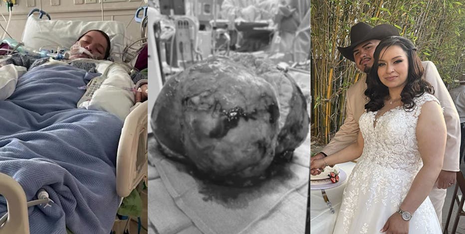California woman gets married after lifesaving surgery to remove 40-pound tumor