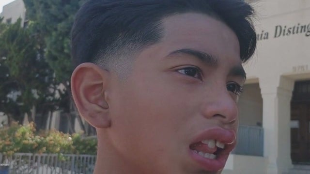 LA teen allegedly beaten by classmate with brass knuckles