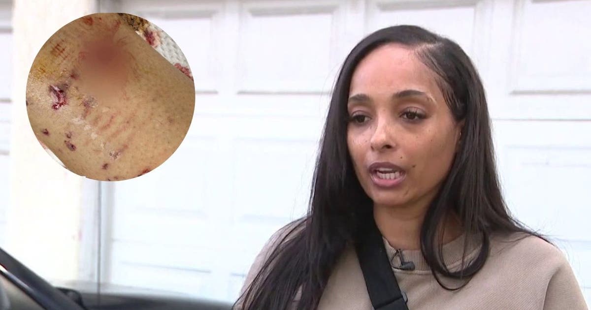 South LA woman attacked by neighbor's pit bull; was told police, animal ...