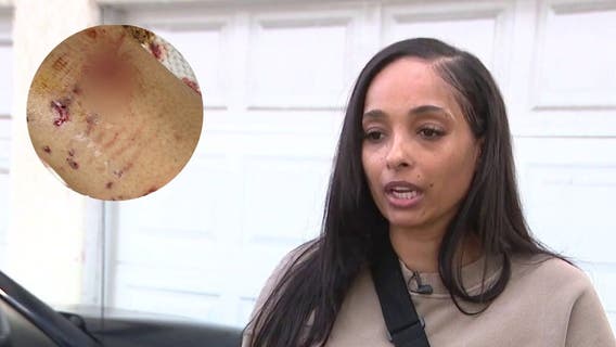 South LA woman attacked by neighbor's pit bull; was told police, animal services can't do anything