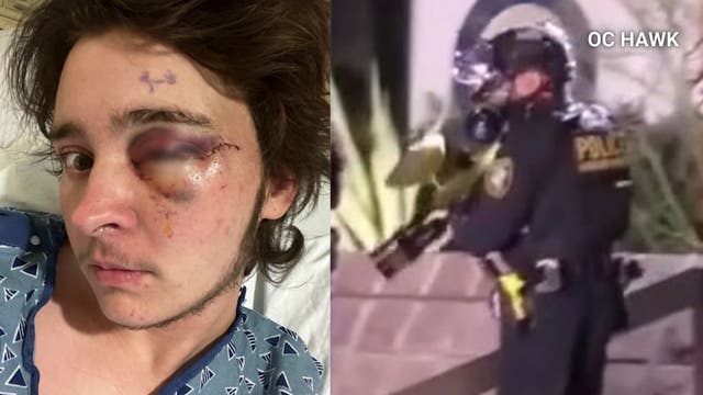Man speaks out after losing sight in one eye during anti-ICE protest in Santa Ana