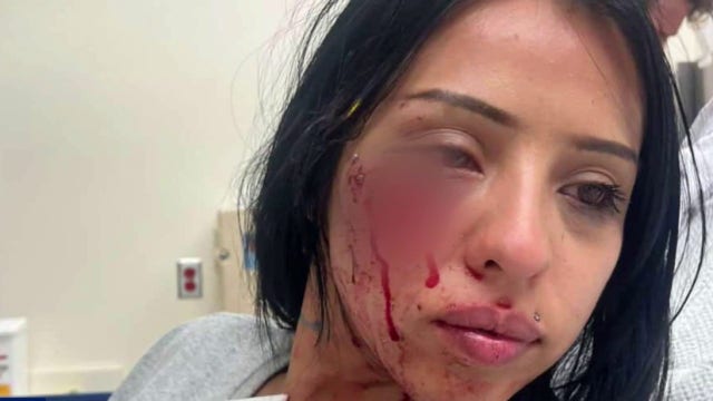 Woman sues LAPD after being shot in the face with paint projectile launcher during anti-ICE protest