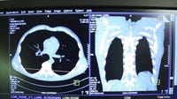 Lung cancer deaths outpace other major cancers as cases rise in young adults