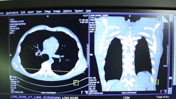 Lung cancer deaths outpace other major cancers as cases rise in young adults