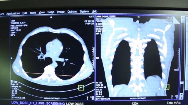 Lung cancer deaths outpace other major cancers as cases rise in young adults