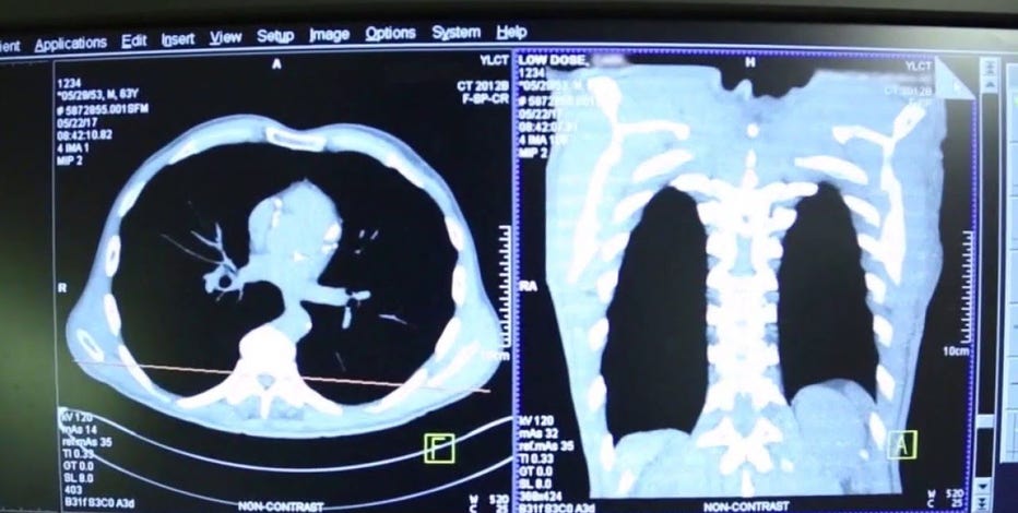 Lung cancer deaths outpace other major cancers as cases rise in young adults