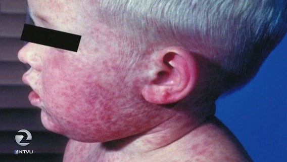 San Mateo County Health warns of potential measles exposure at Panda Express