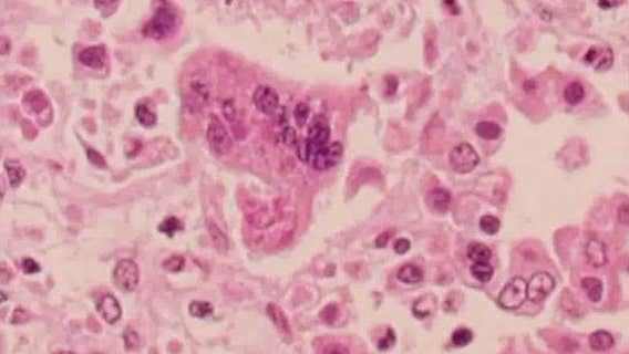 Unvaccinated infant is San Francisco's 1st measles case since 2019