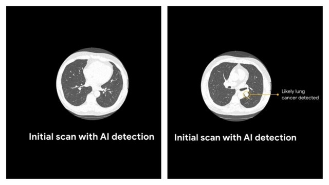 Google AI outperforms radiologists at lung cancer detection