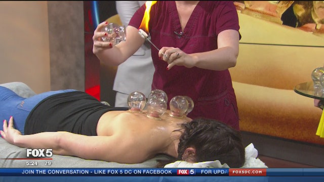 What is cupping? 5 things you need to know about the therapy treatment catching on at the Olympics