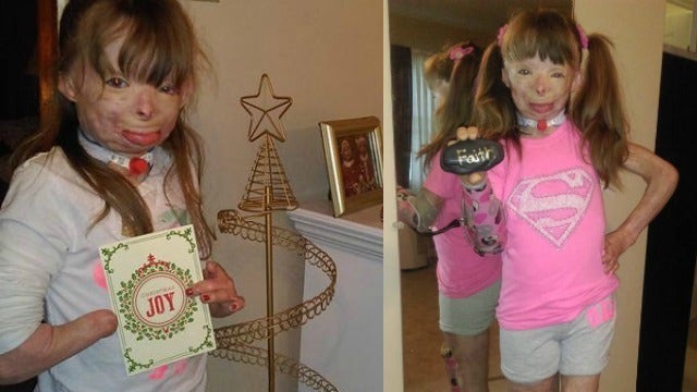 Girl who lost family in fire gets new hand, foot