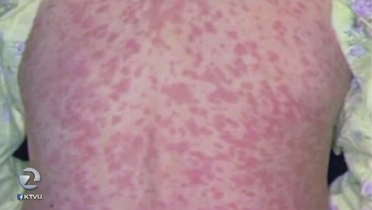 f52d41f6-2nd_case_of_measles_in_Santa_Clara_Count_0_20190329191825