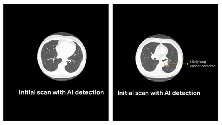 c84ccd31-Google-lung-cancer-detection_1558393510830.jpg