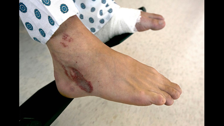 bceb5c0f-Hiker Survives Lighting Strike_1503681437991