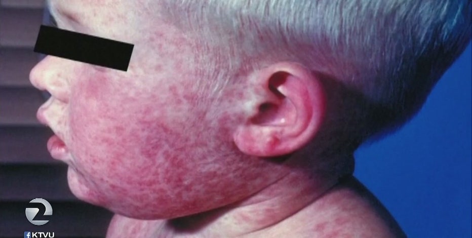 San Mateo County Health warns of potential measles exposure at Panda Express