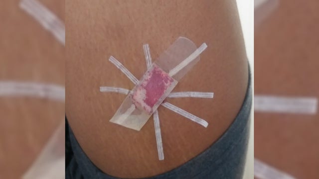 Teen given botched birth control implant at school without parents' permission, mother says