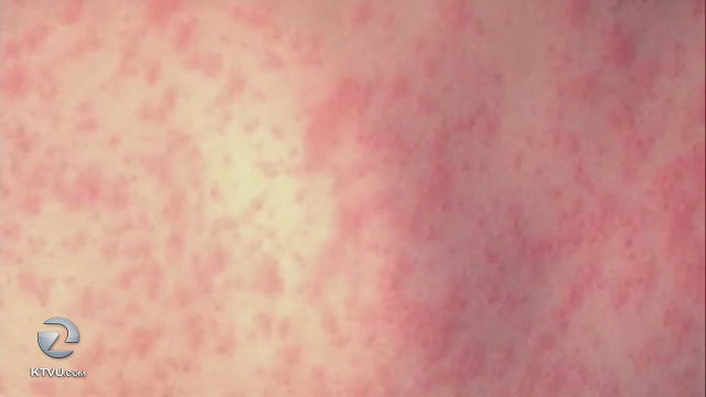 Bay Area joins race to stem measles outbreak in Samoa