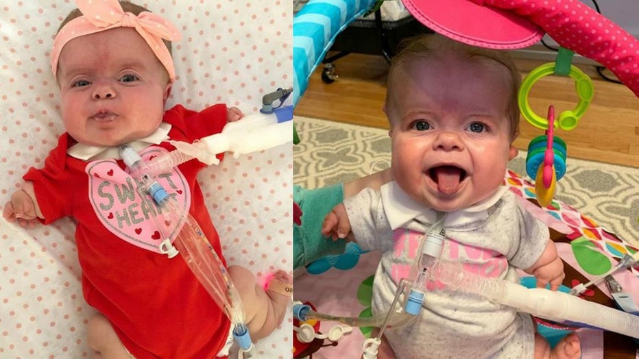 Georgia baby with rare form of dwarfism 'thriving' at home