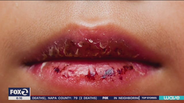 Bay Area baby’s case may be first that links COVID-19 to inflammatory syndrome: report