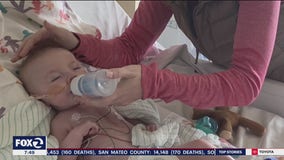 Toddler survives 12 hours of open-heart surgery at UCSF Benioff Children's Hospital