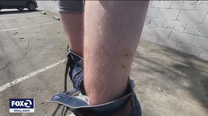 Latest coyote-bite victim speaks out, chalks it up to 'life experience' - Vimarsana News