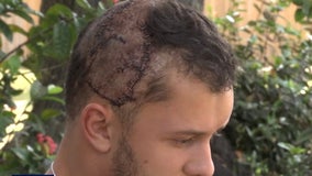 Alligator bites down on Florida man's head